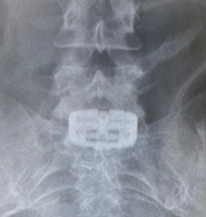 전방 경유 척추 유합술용 높이확장형 케이지 ‘패스락-TA’를 삽입한 첫 수술 사진